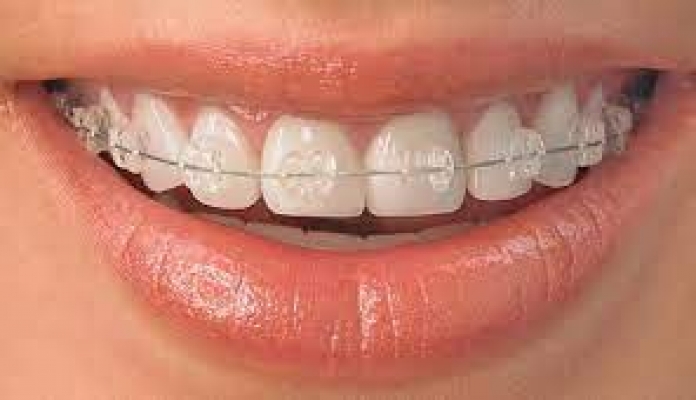 Ortodonti Nedir ?