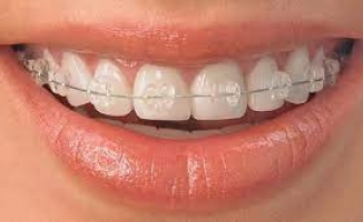 Ortodonti Nedir ?